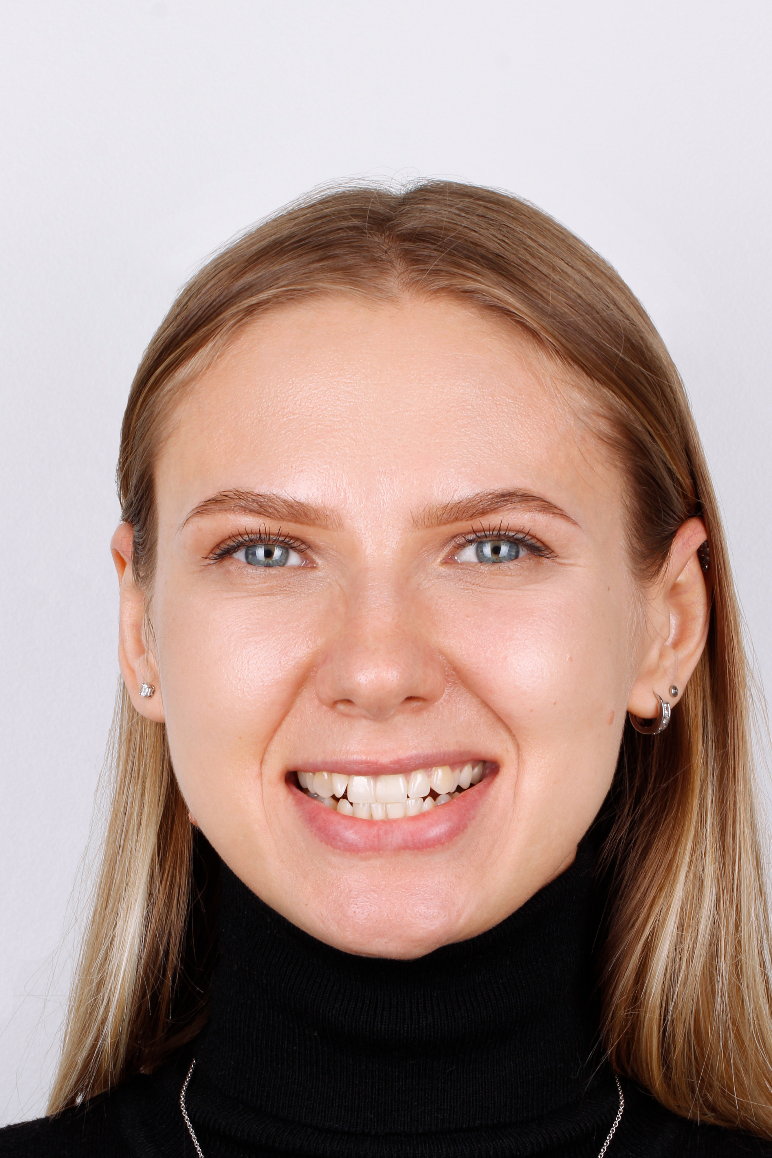 Кейс Саниной - до лечения